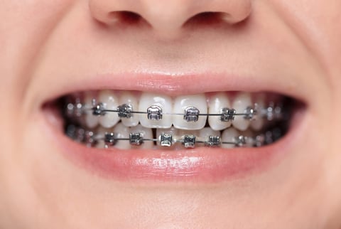Mujer sonriendo con brackets metálicos mostrando tratamiento de ortodoncia