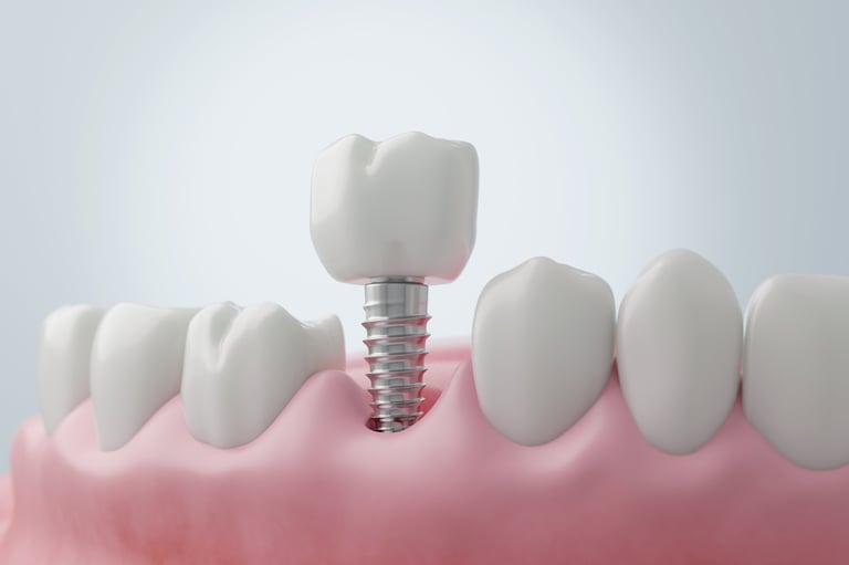 Titanium dental implant installation for a molar tooth replacement, showing the screw placed in the jawbone for oral restoration
