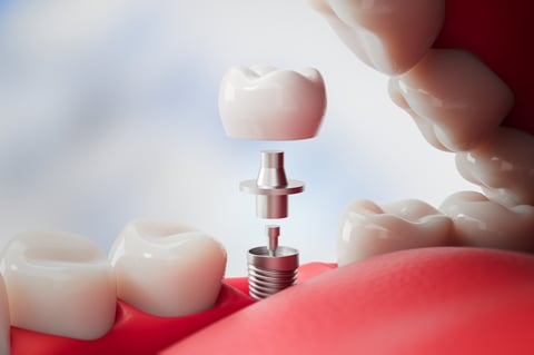 Implantes dentales de alta durabilidad