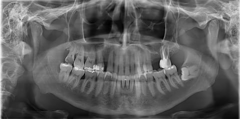 Radiografía panorámica dental mostrando maxilar, mandíbula y estructuras anatómicas para diagnóstico